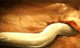 Cận cảnh giun móc hút máu người