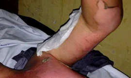 Hắt nước sôi vào mặt bạn tù