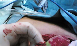 Bị thủng ruột vì nuốt tờ 100 nghìn đồng