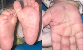 Bé 4 tháng tuổi bị bệnh giang mai bẩm sinh