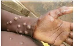 Nóng: Dịch đậu mùa khỉ gia tăng, Bộ trưởng Bộ Y tế yêu cầu ngăn chặn từ cơ sở y tế, cửa khẩu