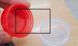 Ca bệnh hiếm báo động thói quen sinh hoạt thiếu an toàn