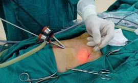 Người phụ nữ nguy kịch vì viên sỏi mật bé xíu 'trở chứng' dù sống chung nhiều năm qua