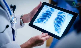 Gia tăng người không hút thuốc mắc ung thư phổi