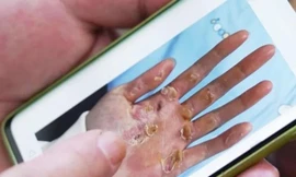 Bức ảnh bàn tay biến dạng của vận động viên