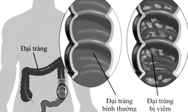 Mô phỏng đại tràng bình thường và đại tràng bị viêm