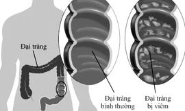 Mô phỏng đại tràng bình thường và đại tràng bị viêm