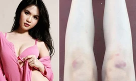 Hoa vương Châu Á gặp nạn; Ngọc Trinh khoe đôi chân bầm tím