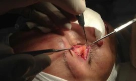 Kinh hoàng silicon chui lên hốc mắt