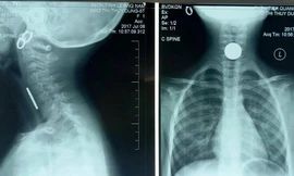 Gắp thành công đồng xu 500 đồng mắc kẹt trong thực quản bé gái.