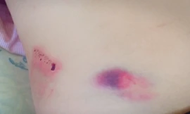 Thương tích trên người ông Th. Ảnh B.N