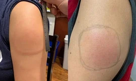 Tại sao nhiều người xuất hiện triệu chứng 'cánh tay COVID' sau khi tiêm vaccine?