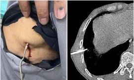 Đang cắt cỏ, người đàn ông bị dây kẽm xuyên vào lồng ngực, đâm thủng phổi