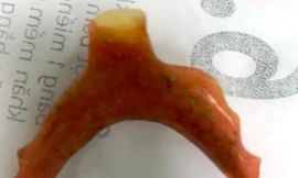 Nuốt hàm răng giả khi uống thuốc, người đàn ông ở Quảng Nam nhập viện cấp cứu