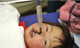 Phẫu thuật thành công bé gái bị tua vít đâm sâu vào mũi