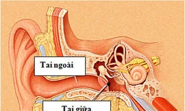 Thủng màng nhĩ do viêm tai giữa