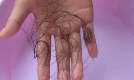 Nguyên nhân gây rụng tóc