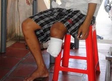 Bị cắt chân, bệnh nhân đòi bồi thường 204 triệu