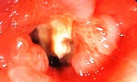 Dị vật xương cá thời điểm còn nằm trong phế quản cụ ông 74 tuổi.