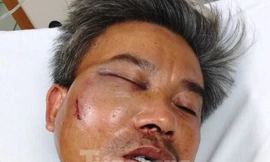 Nạn nhân Lê Song Toàn bị đánh gãy hàm, vỡ xoang, tỷ lệ thương tật 22%.