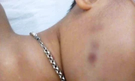 Sức khỏe của cháu L. được tiên lượng rất xấu