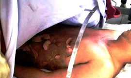 Dừng đổ xăng lẻ ven đường, anh Võ Trọng N. bất ngờ bị cháy sém nửa người với mức bỏng lên đến 30%