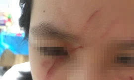 Ba giáo viên ở Hà Nội bị kỷ luật vì để nữ sinh lớp 5 bị bạn đánh rách mặt trong lớp học