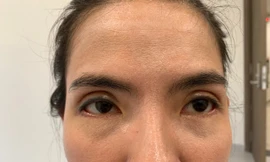 Mắt phải của chị Hồng bị lệch mí sau phẫu thuật.