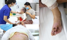Các vị trí vết bỏng sâu nghiêm trọng của trẻ. Ảnh: BS cung cấp