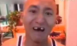 Chàng trai mất hết răng cửa vì tham gia thử thách ăn ngô bằng máy khoan