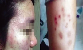 Một học sinh của Trường Ngoại ngữ Thường Châu bị nổi nốt đỏ lạ trên da.