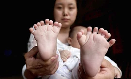 Theo Nhân dân Nhật báo, bé Hồng Hồng 3 tháng tuổi có tới 31 ngón tay và chân, đặc biệt không có ngón tay cái.