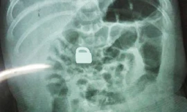 Hình chụp X-quang cho thấy chiếc ổ khóa nằm gọn trong bụng của bé 2 tháng tuổi