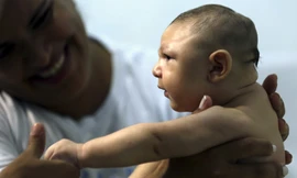Bé Juan Pedro mắc chứng đầu nhỏ vì Zika ở Recife, Brazil
