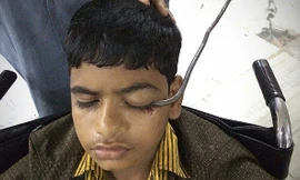 Cậu bé Md Baba Qureshi bị móc sắt đâm xuyên mắt và đã được phẫu thuật khẩn cấp để loại bỏ dị vật.