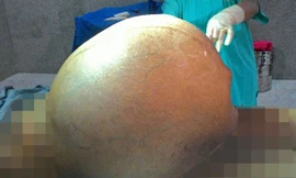 Chị Kamlesh Devi phải trải qua ca phẫu thuật kéo dài 3 tiếng đồng hồ để lấy khối u nặng 95kg