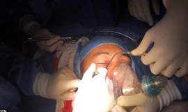 Các bác sỹ phẫu thuật lấy lựu đạn ra khỏi mặt binh sỹ