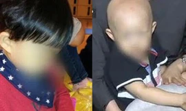 Từ một cậu bé có mái tóc đen dày, giờ bé Chang đã thành trọc đầu chỉ sau 1 tuần uống thảo dược.