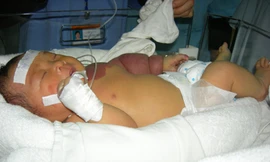 Bé sơ sinh khổ vì u máu khổng lồ