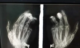  Phim chụp X-quang cho thấy ngón út của bệnh nhân bị mất 2 đốt.
