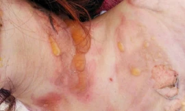 Vết thương trên người D.