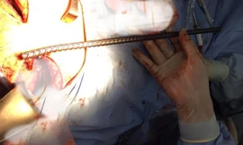 Thanh sắt lấy ra từ lồng ngực nạn nhân