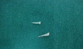 Bé hai tuổi suýt mất mạng vì hóc xương cá