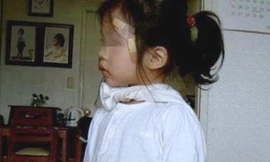  Bé gái bốn tuổi có 2 bộ phận sinh dục nam, nữ 