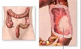 Vì sao bị viêm loét đại trực tràng chảy máu?