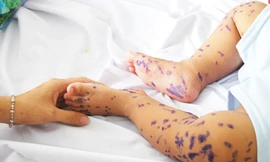Cứu sống bệnh nhi nguy kịch vì tay chân miệng
