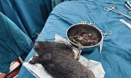 Bé gái 12 tuổi 'ăn' gần 1kg tóc, lấp kín hết dạ dày