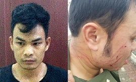 Hoàng Văn Trường và nhân viên sân bay bị hành hung gãy 4 răng cửa.