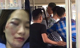 Chị H. bị nhóm thanh niên đánh thâm tím mặt.