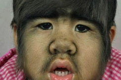 Em bé 4 tuổi mang gương mặt 'người sói'